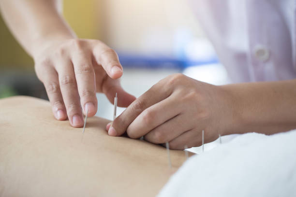 Acupuncture Relieves Pain